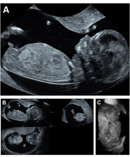 First Trimester Anomaly Scan at Trichy Fetal Medicine and Fertility Centre
